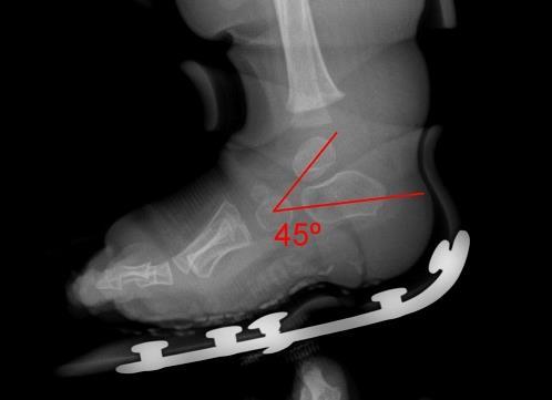 The thigh cuff is attached to a foot shell that has a plantar surface with medial wall that is configured into forefoot abduction using a spiral of plastic that travels around the tibia