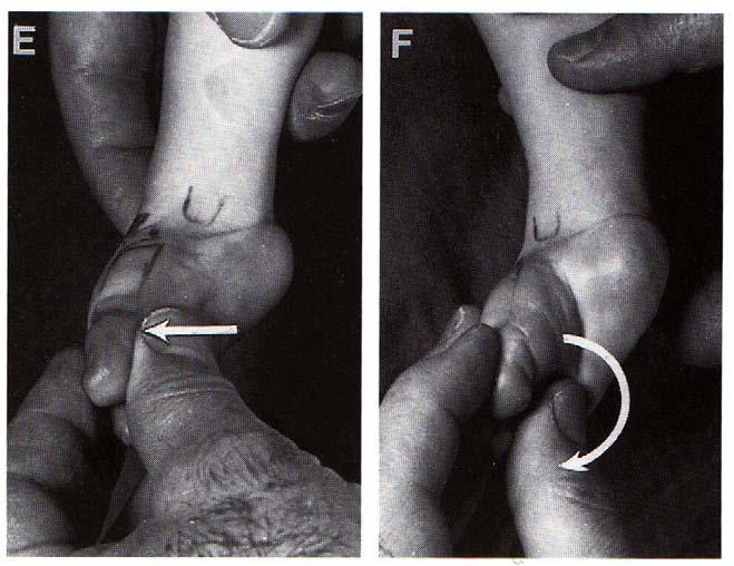 Cavus Correction Correct: Abduct forefoot in supination (E)