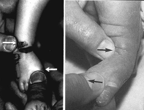 Varus & Medial Deviation Correction Correct: Abduct foot in supination while applying counter pressure against the head of the talus