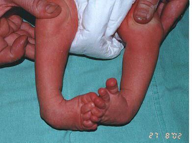 Complex Clubfoot Observe crease across sole of foot