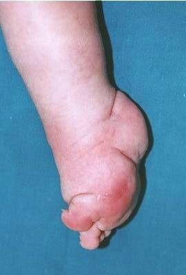 Complex Clubfoot: Traditional Method Severe crease on