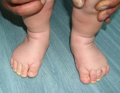 Complex Clubfoot: New Method Results No