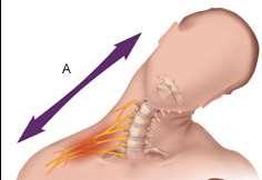 Traction Injury Most common mechanism described Upper trunk BP injury Blocking