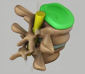 Unit 1: Normal Spine Anatomy Intervertebral Disc The intervertebral disc sits between the weight bearing vertebral bodies, servicing the spine as shock absorbers.