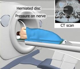 14) CT Scan with myelogram CT Scan with myelogram a type of medical imaging which is done by injecting