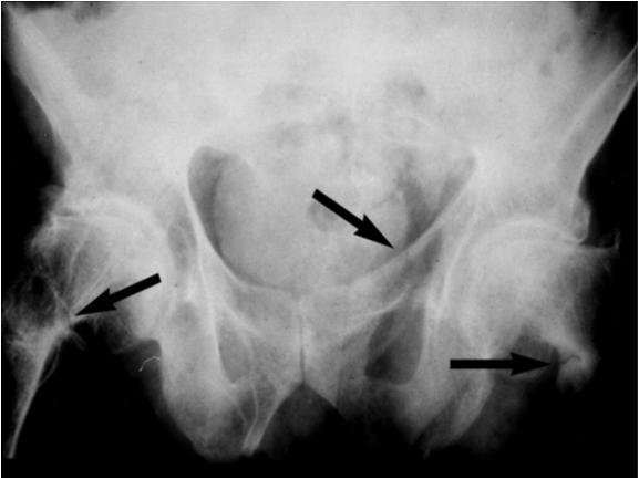 Radiologic Findings Vitamin D Deficiency - Rickets Defective mineralization of cartilage in the