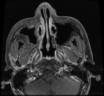 auriculotemporal nerve: small