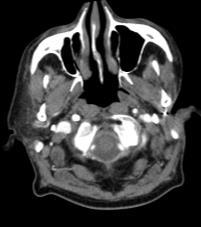 Auriculotemporal nerve: Perineural