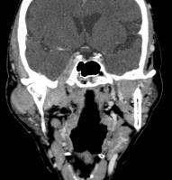 of neural foramina, canals, or fissures (CT) Cutaneous