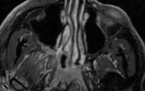 Space Middle Cranial Fossa Orbit Pterygopalatine Fossa Muscular