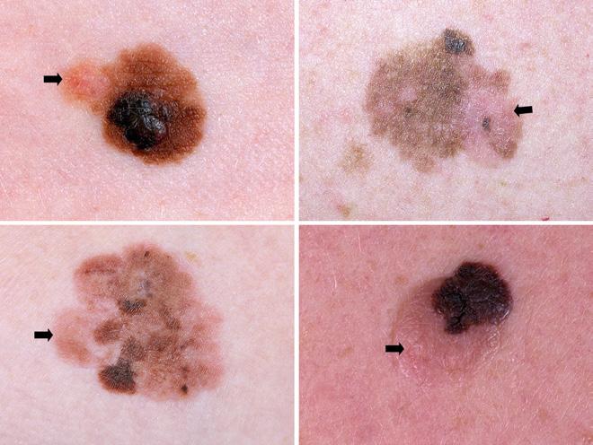 Differences Between de novo and Nevus-Associated Melanomas The mean age of patients diagnosed with de novo melanomas was 68.2 years (SD: 14.8 years).