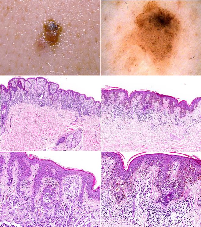 Figure 3. Clinical-dermatoscopic-pathologic correlation of a melanoma-associated nevus. [Copyright: 2018 Alendar et al.] and thus lower than in most other studies on this topic [2].