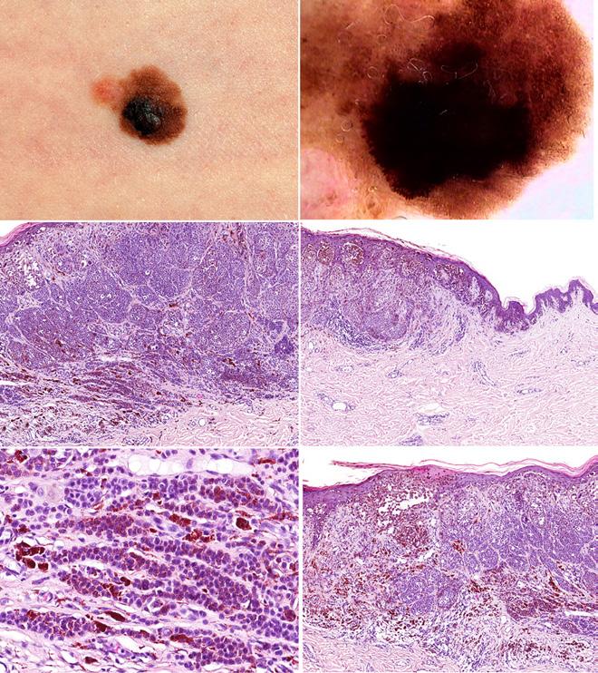 This resulted in a considerable proportion of cases in which we could not decide if there was an associated nevus or not.