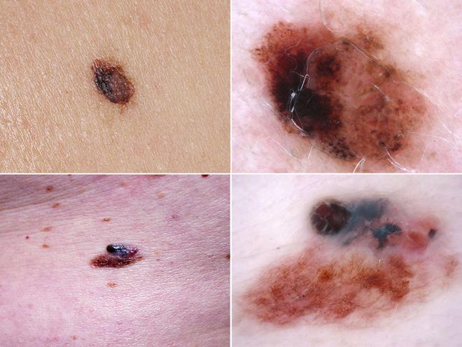 References Figure 5. Clinical and dermatoscopic images of two nevus-associated melanomas. [Copyright: 2018 Alendar et al.