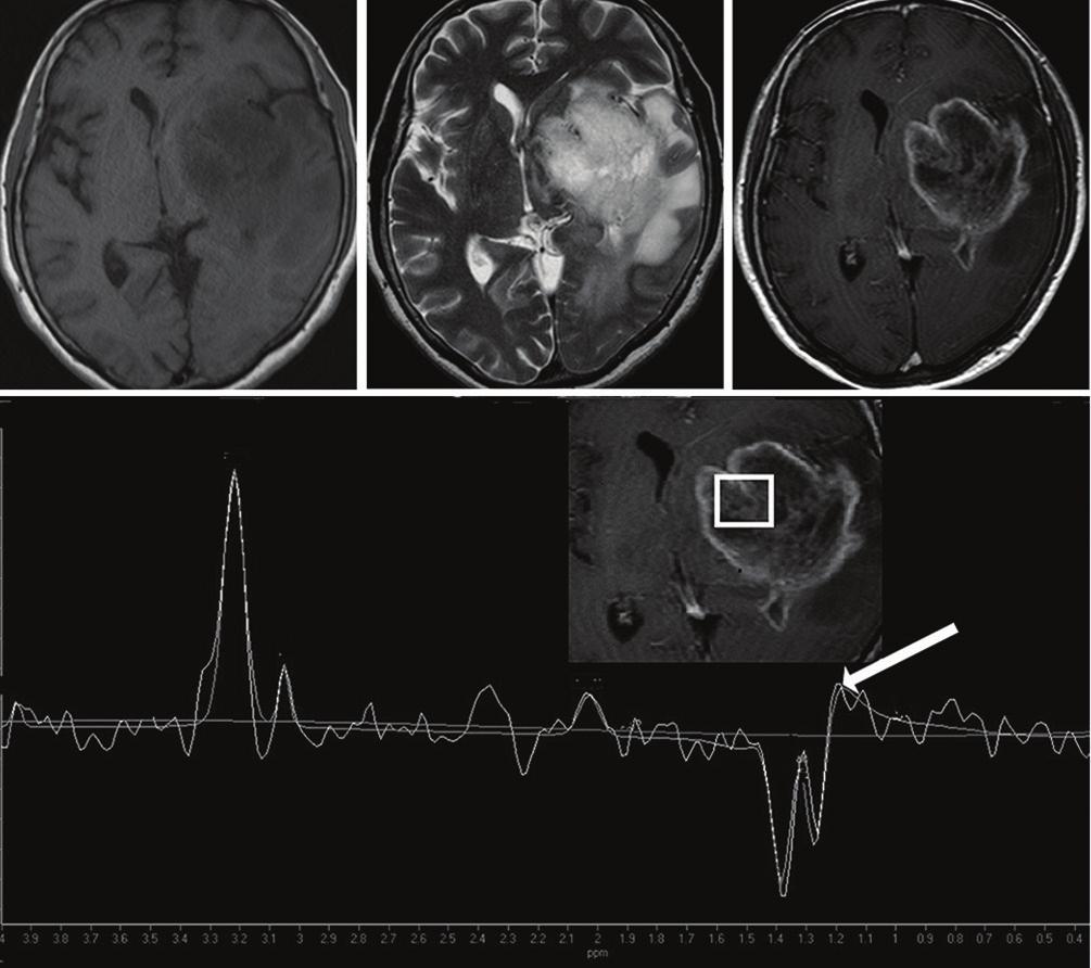 H. Nakamura et al. A B C D Fig 2. Glioblastoma in a 69-yearold woman. (A) Axial T -weighted images (T WI) shows an irregular low signal intensity mass mainly located in the left basal ganglia.