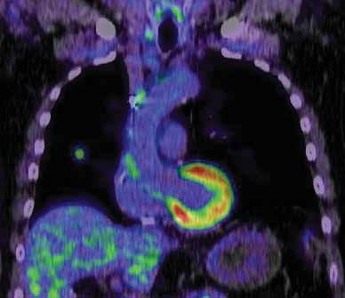 A solitary pulmonary nodule (SPN) is defined radiologically as an intraparenchymal lung lesion that is <3 cm in diameter and is not associated with atelectasis or adenopathy [6].