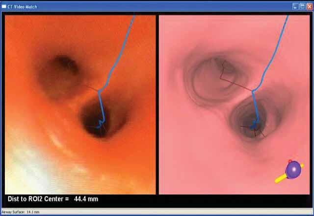 NAVIGATIONAL BRONCHOSCOPY R. EBERHARDT AND J. VAN DER HORST In the LungPoint system the virtual bronchoscopy as well as the real endoscopic image are visible simultaneously.