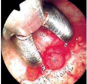Full thickness parietal pleural biopsies can be obtained using the insulated-tip diathermic knife during flexi-rigid pleuroscopy.