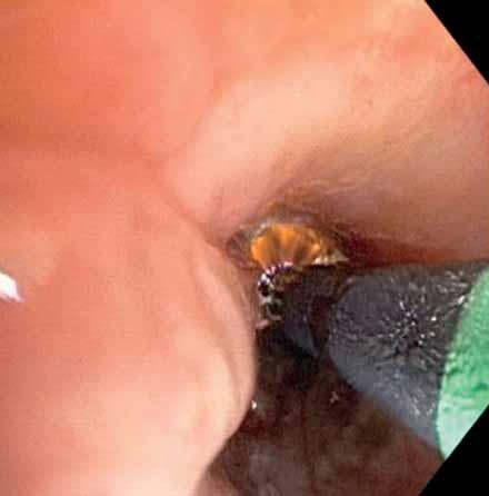 HAEMOPTYSIS G.Z. CHENG AND M.M. WAHIDI a) b) c) d) Figure 2. a) Electrocautery to a bronchus intermedius lesion. b) Argon plasma treatment to a tracheal lesion.
