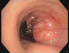 b) Bronchoscopy shows a tumour at the right lateral wall with an intraluminal component and 75% tracheal stenosis, demonstrating an adenoid cystic carcinoma at histopathology.