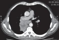 c) Bronchoscopy showing a necrotic intraluminal tumour with a smaller airway diameter compared with the left main bronchus due to extrinsic compression, demonstrating a squamous cell carcinoma at