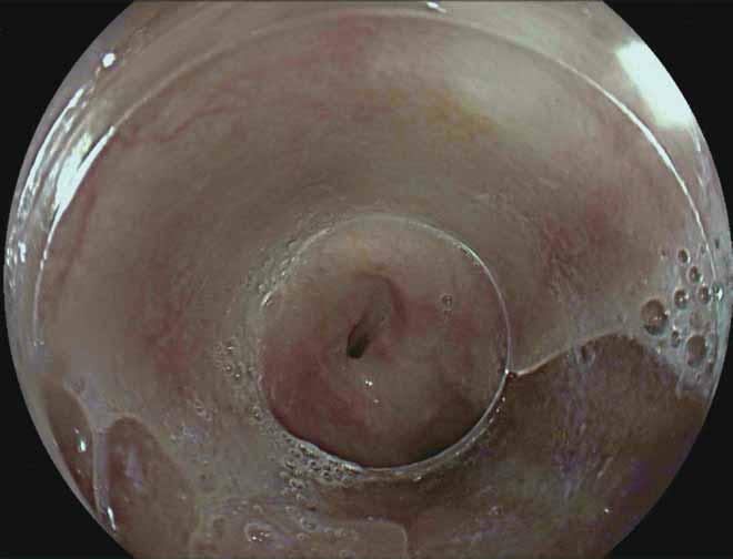 oesophagogastroscopy. Most malignant TOFs occur spontaneously due to tumour invasion or as a complication during or after radiochemotherapy for oesophageal, lung or tracheal cancer.