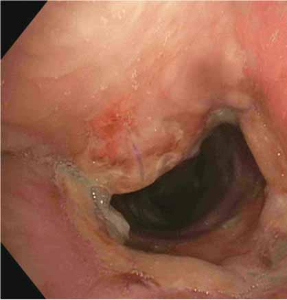 A retrospective series of 218 patients subjected to sleeve lobectomy for nonsmall cell lung cancer reported a bronchial anastomotic complication in 14 patients: seven patients required re-operation,