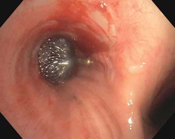 Alveolopleural fistulas Alveolopleural fistula as a complication after thoracic surgery Thoracic surgery to the lung, such as pleural decortication for pleural