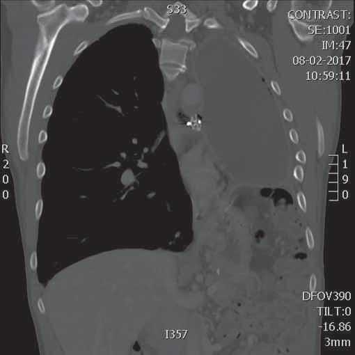 segmentectomy or lobectomy for lung cancer, may be complicated by an alveolopleural fistula.