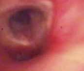 features Image 0 No inhalation injury Absence of carbonaceous deposits, erythema,