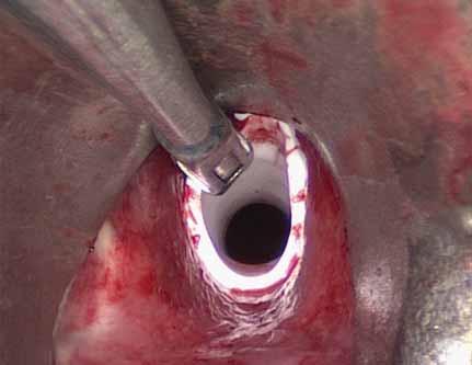 LARYNGOSCOPY A.J. KINSHUCK AND G.S. SANDHU Figure 5. Silicone stent inserted into the trachea with grasping forceps. Intra-operative image taken by the authors with patient consent.