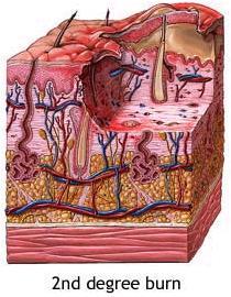 Burns Cont. Second-degree burns (Partial Thickness) Epidermis and upper regions of dermis are damaged.