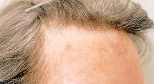 Androgenic alopecia Most common form Diffuse thinning, more marked in frontal and parietal Higher levels of 5 α reductase, more androgen receptors and lower