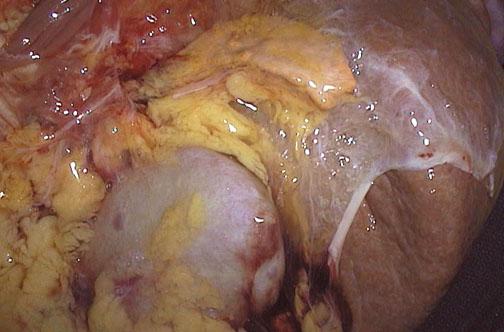 Adrenal Gland in situ Described as loose flesh for the left