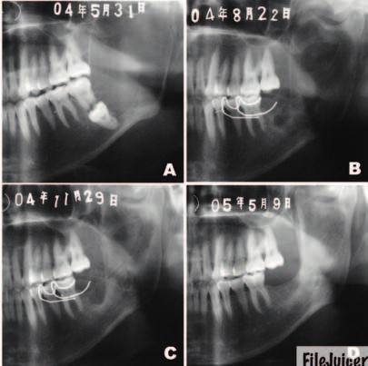 A) A unilocular radiolucency lesion with an impacted third molar. B) The lesion after 3-month suction drainage.