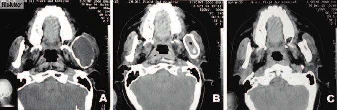 Liu et al Publication Fig 3 Axial CT scans showing the lesion in the left ramus of maximum section. A) An expansile low-density lesion with interrupted margins in the left ramus bee treatment.