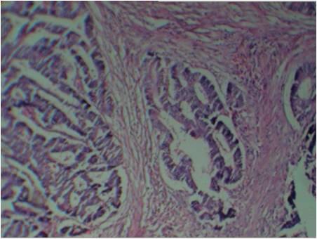 HPE showing moderately differentiated adenocarcinoma