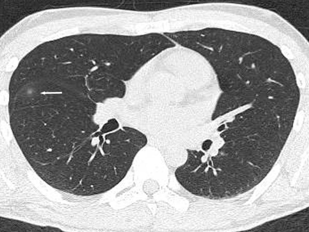 Table 1: Table 1 Thoracic CT Findings in 30 Patients Fig. 1: Fig.