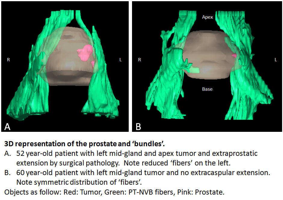 ECE 2 mm close to NVB: min. T3a, R- DTI: position of PCa to NVB T c. H. Morales, S. Verma, Cincinnati, USA Clinical questions in PCa 1.