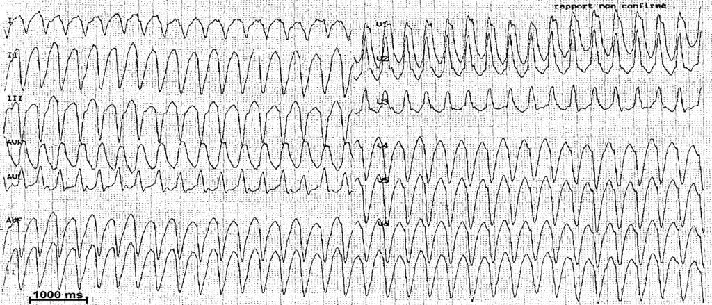 Favours Ventricular Tachycardia QRS width: 186 ms North