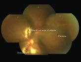 There is little or no vitritis. Usually significant optic nerve involvement with atrophy is seen leading to significant visual loss.