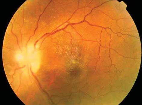 The recurrent retinitis measured 2 disc diameters just below the optic disc; the old healed scar with associated segmental arteritis (Kyreileis sign) is seen below the inferior arcade. (6.