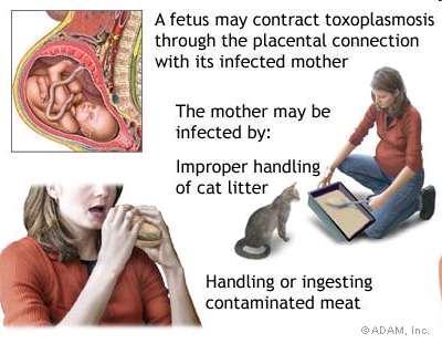 Congenital Toxoplasmosis Congenital infection develop in