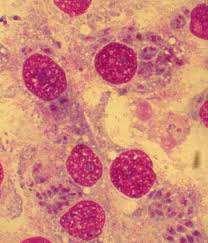Suspected toxoplasmosis can be confirmed by finding