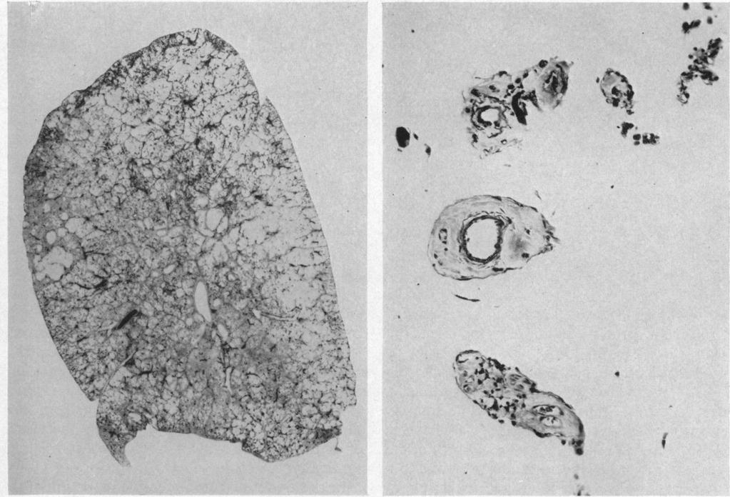 584 JAMES AND THOMAS 9%~~~~~~~~~~~~~~~~~~~~~~~~~~~~t &.4. 4-1~~~~~~~~~~~~~~~~~~~~~~~~~~*> FIG. 1 (A).-Section of a lung from a man aged 48 who (B).