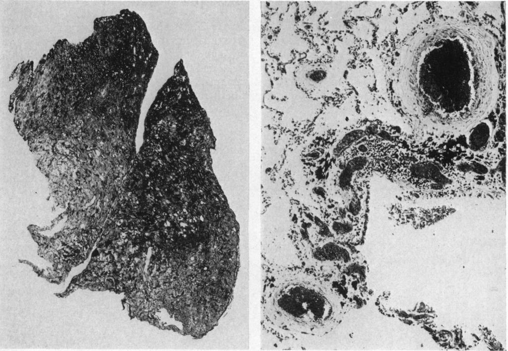 586 JAMES AND THOMAS j., E S.tN 't{{1 ' t f w, '4 * ~! a ;i g * - u 1 *, r FIG. 3(A).-Section of a lung from a man aged 56 who (B).
