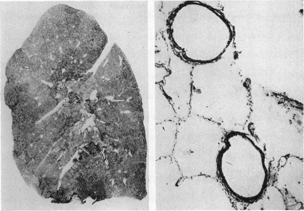 SMALL PULMONARY ARTERIES IN CHRONIC LUNG DISEASE FIG. 4(A).-Section of a lung from a woman aged 57 who (B).-Normal small arteries from the specimen shown had had asthma for over 30 years.