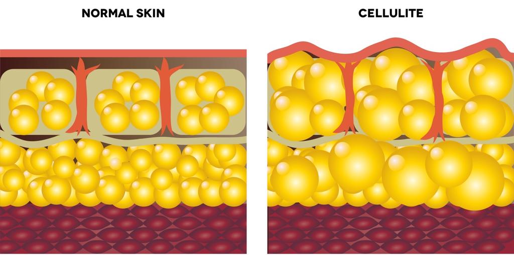 What is Cellulite? Cellulite is an aesthetical problem which affects 90% of post adolescent women and a small percentage of men, who consider it as an undesired skin disruption to solve.