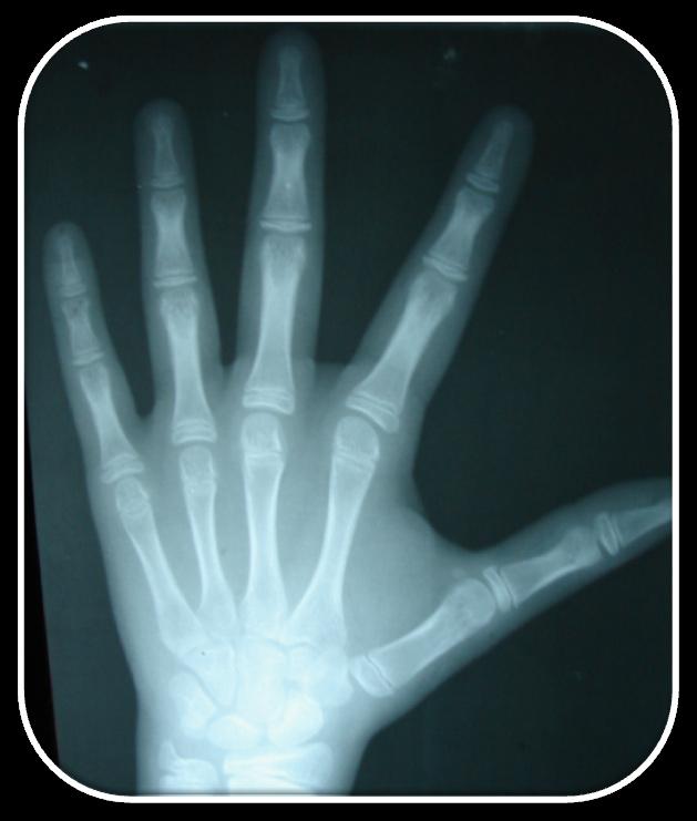 Skeletal maturation evaluation indexes Fig. 1. Hand and fist radiography of an individual that was in SMI stage 8. The sesamoid bone is observed. Fig. 2.