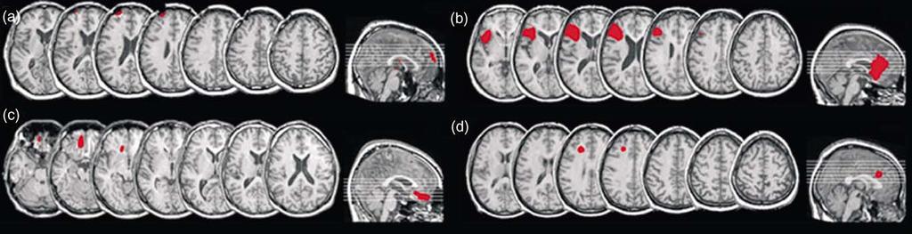 2432 A.C.H. Lee et al. / Neuropsychologia 40 (2002) 2420 2437 Fig. 6. (a d) Structural MRI scans of unilateral left frontal-lobe patients (where available). Red shading highlights lesion.